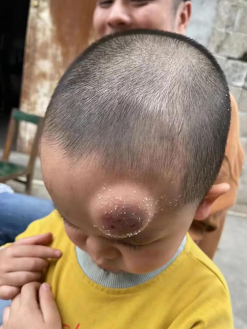 新生儿头上有血包图片正常吗？需要担心吗？-第1张图片-郑州医学网