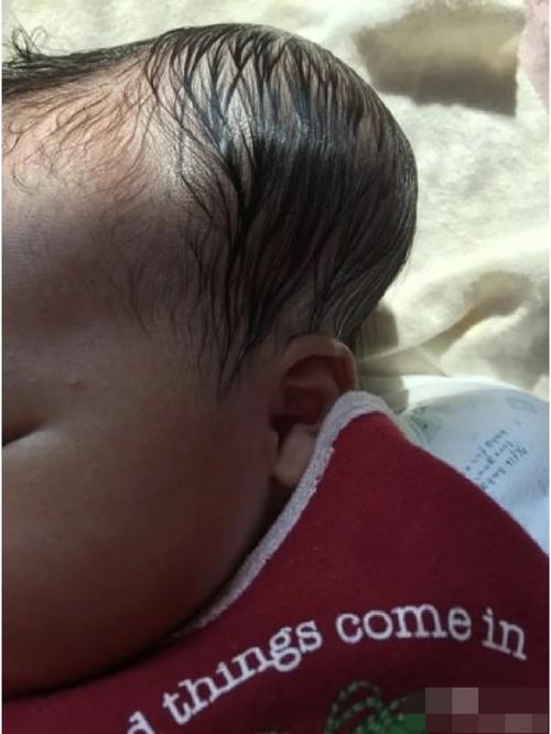 新生儿头上有血包图片正常吗？需要担心吗？-第2张图片-郑州医学网