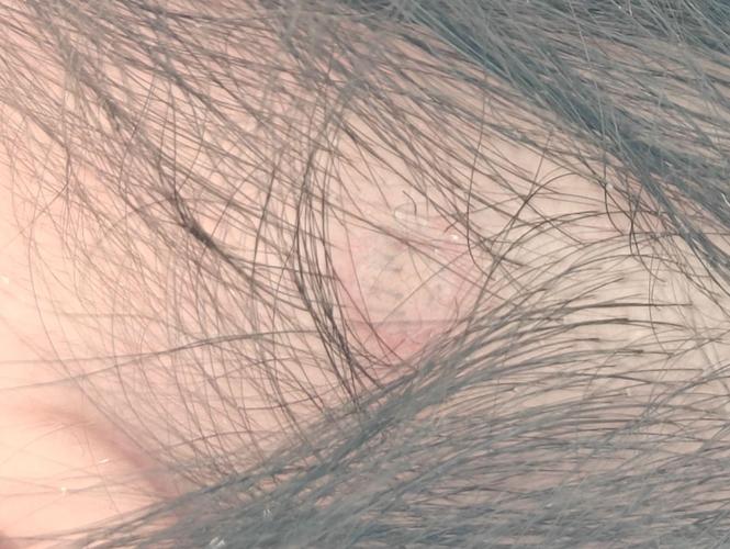 新生儿头上有血包图片正常吗？需要担心吗？-第3张图片-郑州医学网