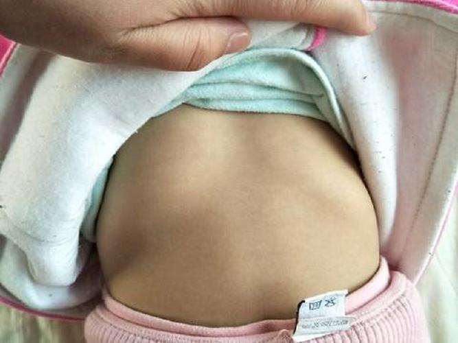 新生儿剑突和鸡胸如何区分？是正常生理结构还是异常病症？-第2张图片-郑州医学网