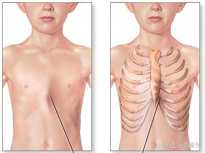 新生儿剑突和鸡胸如何区分？是正常生理结构还是异常病症？-第3张图片-郑州医学网