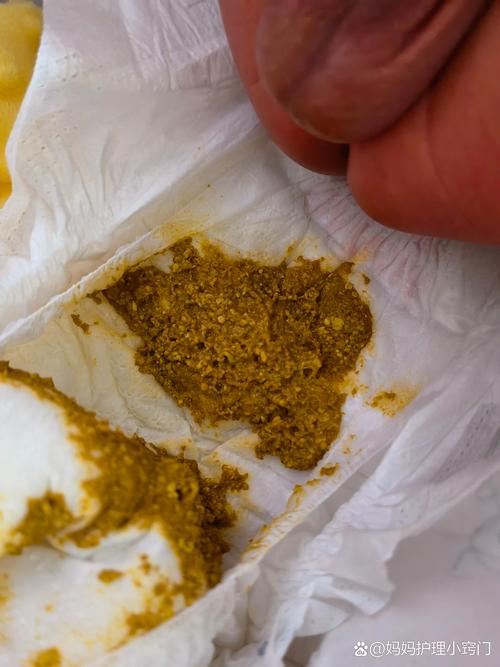 新生儿黄疸吃药后大便颜色变深是正常现象吗？需要调整用药吗？-第2张图片-郑州医学网