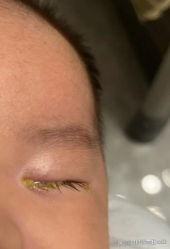 新生儿白眼球发黄是黄疸吗？需要就医检查吗？-第1张图片-郑州医学网