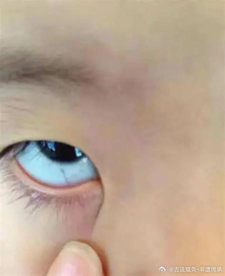 新生儿白眼球发黄是黄疸吗？需要就医检查吗？-第3张图片-郑州医学网