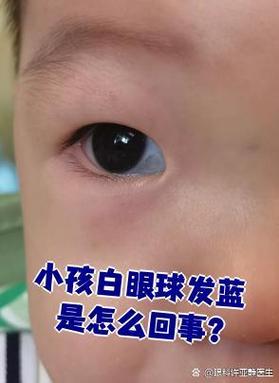 新生儿白眼球发黄是黄疸吗？需要就医检查吗？-第2张图片-郑州医学网