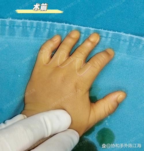新生儿大拇指并指图片，这种先天畸形需要手术矫正吗？-第1张图片-郑州医学网