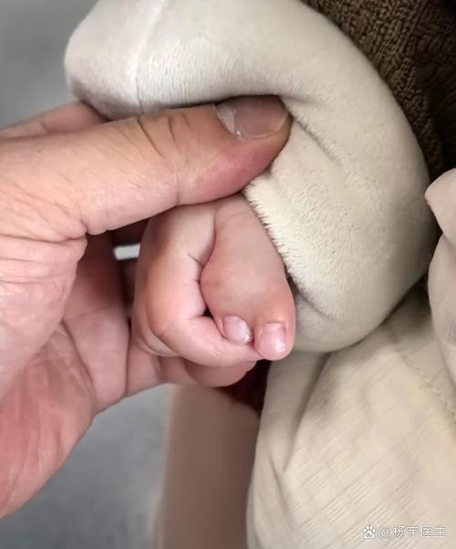 新生儿大拇指并指图片，这种先天畸形需要手术矫正吗？-第2张图片-郑州医学网