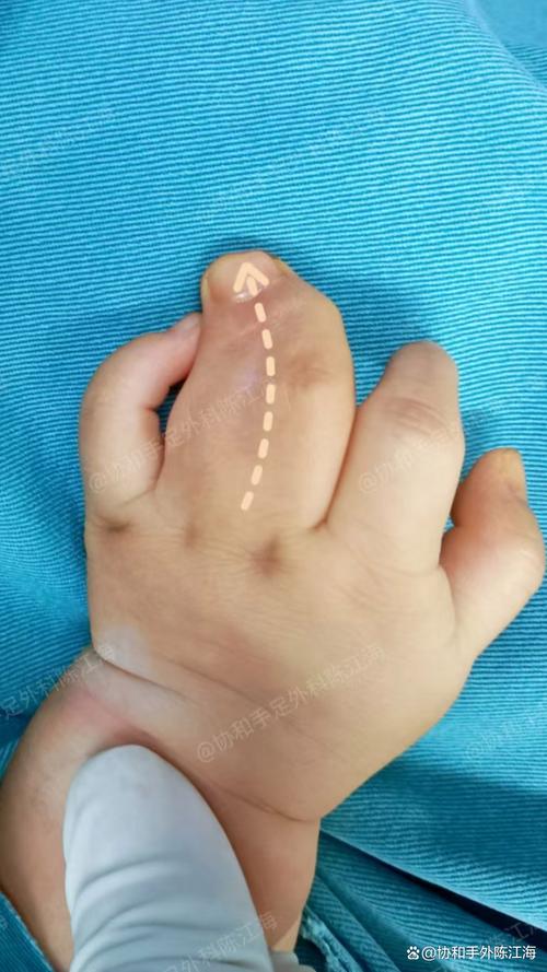 新生儿大拇指并指图片，这种先天畸形需要手术矫正吗？-第3张图片-郑州医学网