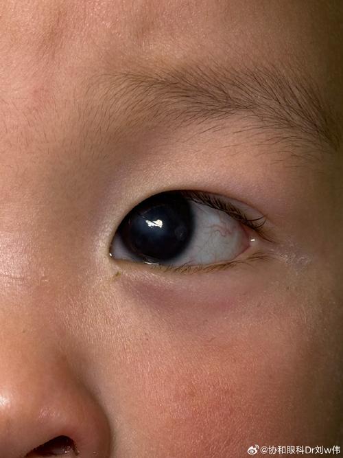 新生儿眼睛感觉看不见是正常现象吗？需要警惕哪些眼部问题？-第2张图片-郑州医学网