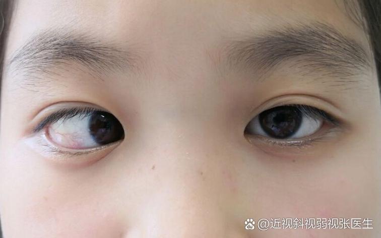 新生儿眼睛感觉看不见是正常现象吗？需要警惕哪些眼部问题？-第1张图片-郑州医学网