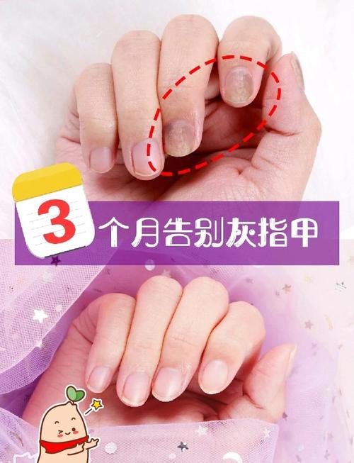 怀孕期间得了灰指甲怎么办？安全有效的治疗方法有哪些？-第1张图片-郑州医学网