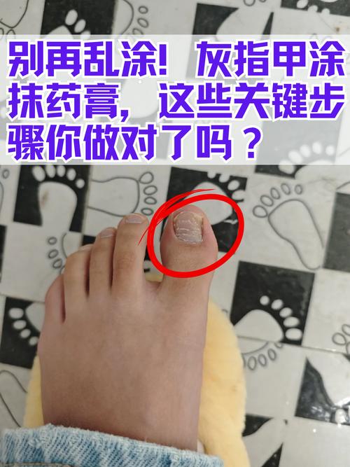 怀孕期间得了灰指甲怎么办？安全有效的治疗方法有哪些？-第3张图片-郑州医学网