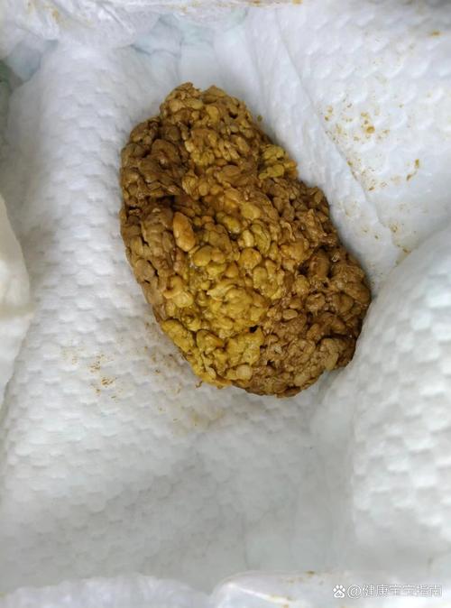 新生儿便便里的奶瓣正常吗？附图片详解不同形态代表什么？-第1张图片-郑州医学网