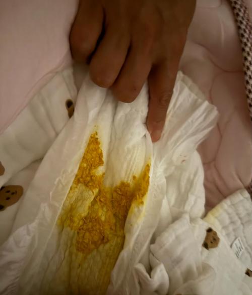 新生儿便便里的奶瓣正常吗？附图片详解不同形态代表什么？-第2张图片-郑州医学网