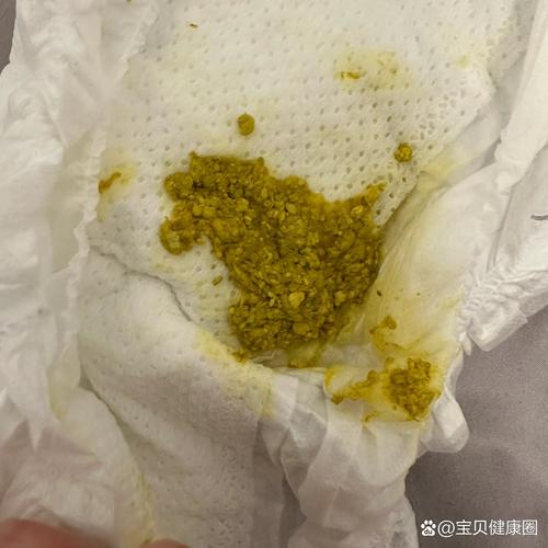 新生儿便便里的奶瓣正常吗？附图片详解不同形态代表什么？-第3张图片-郑州医学网
