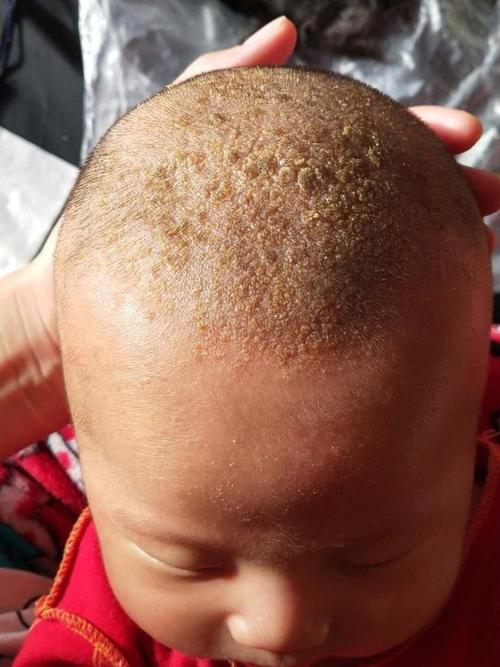 新生儿头上溢脂性皮炎怎么护理？会影响发育吗？反复发作怎么办？-第1张图片-郑州医学网
