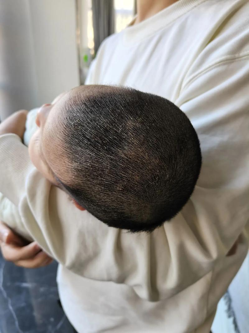 新生儿头上溢脂性皮炎怎么护理？会影响发育吗？反复发作怎么办？-第2张图片-郑州医学网