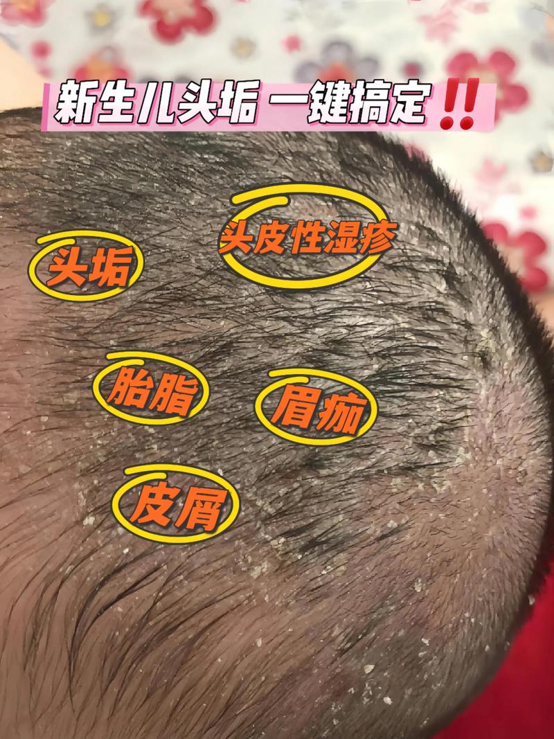 新生儿头上溢脂性皮炎怎么护理？会影响发育吗？反复发作怎么办？-第3张图片-郑州医学网