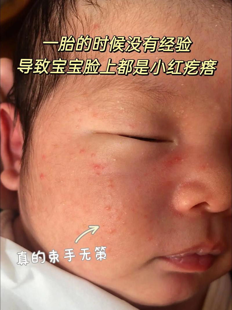 新生儿脸上红血丝是正常现象还是疾病信号？如何区分生理性与病理性红血丝？-第1张图片-郑州医学网
