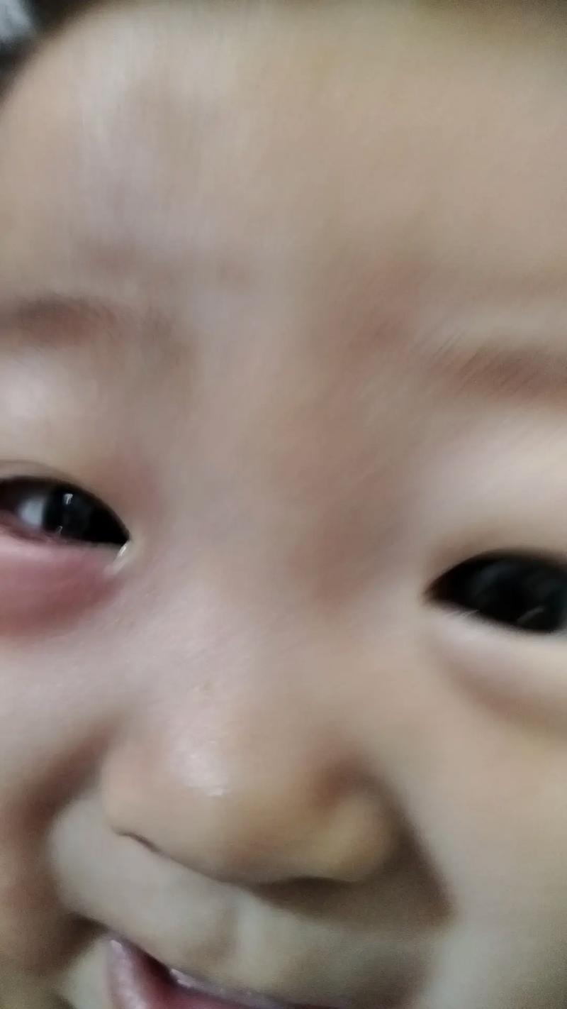 新生儿眼睛充血是正常现象还是异常信号？需要关注哪些潜在风险？-第1张图片-郑州医学网