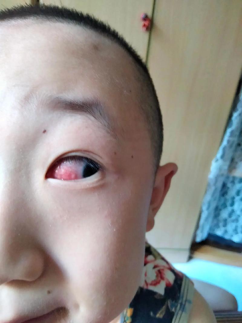新生儿眼睛充血是正常现象还是异常信号？需要关注哪些潜在风险？-第2张图片-郑州医学网
