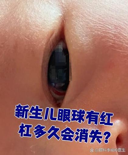 新生儿眼睛充血是正常现象还是异常信号？需要关注哪些潜在风险？-第3张图片-郑州医学网