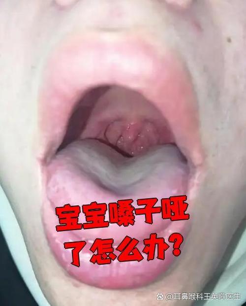 新生儿喝奶后喉咙响是正常现象还是异常信号？需警惕哪些潜在问题？-第1张图片-郑州医学网