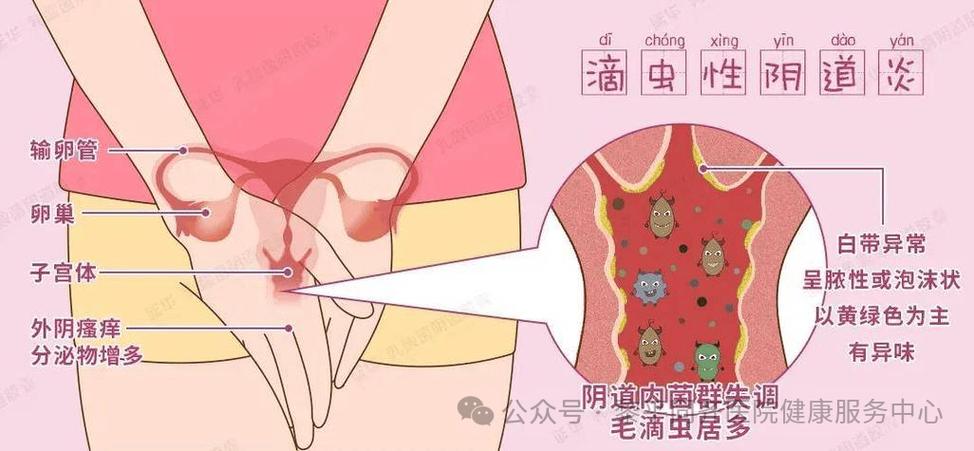 孕期出现黄绿色分泌物且伴有瘙痒，是何种异常信号？需警惕哪些妇科问题？-第3张图片-郑州医学网