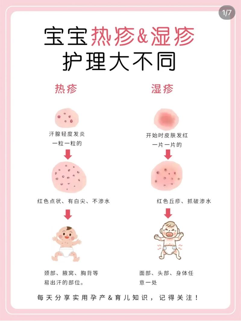 儿童湿疹是怎么引起的-第2张图片-郑州医学网