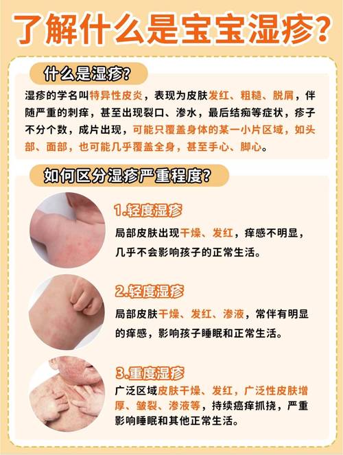 儿童湿疹是怎么引起的-第3张图片-郑州医学网