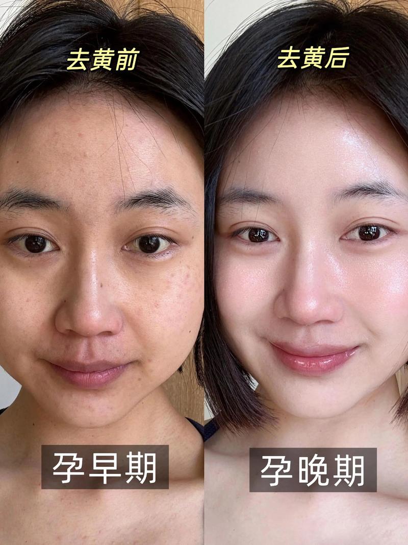 怀孕期间皮肤发黄是什么原因？该如何改善才能恢复健康光泽？-第1张图片-郑州医学网