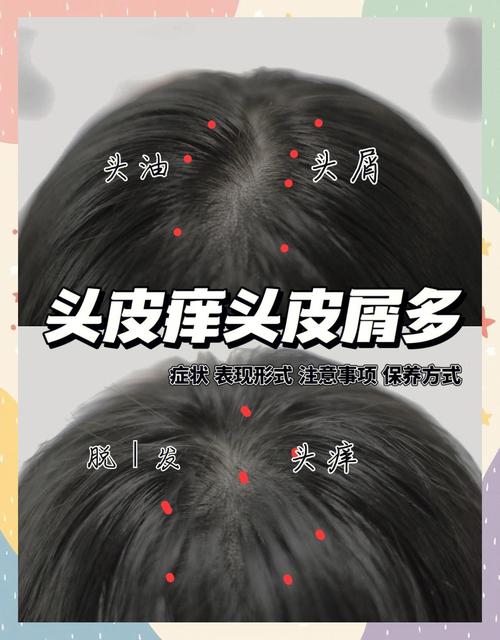 怀孕期间头皮奇痒难忍，到底该怎么办才安全有效？-第3张图片-郑州医学网