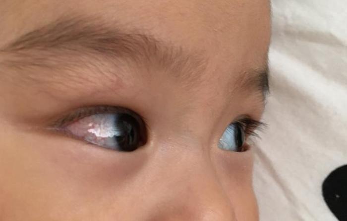 新生儿眼白发蓝是正常现象还是异常信号？需要关注哪些潜在健康问题？-第1张图片-郑州医学网