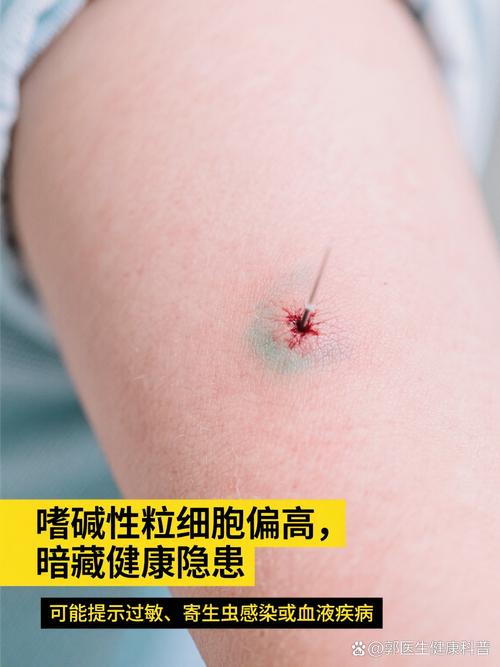 儿童嗜碱性粒细胞偏高-第1张图片-郑州医学网