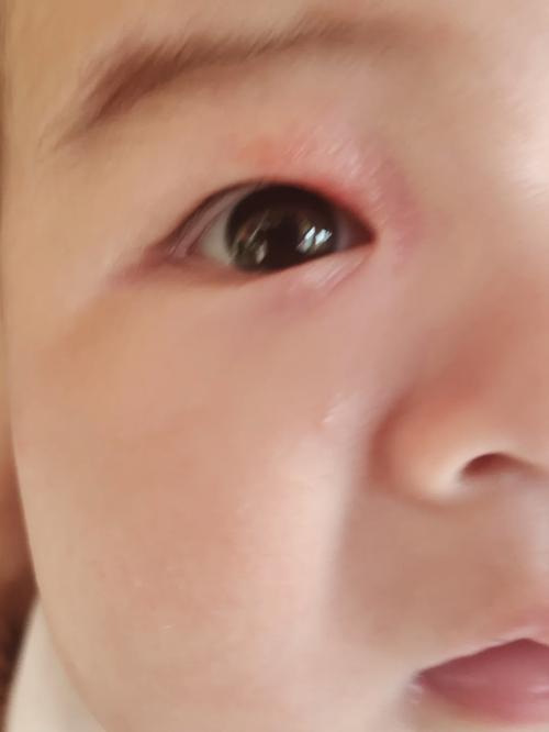 新生儿右眼肿是正常现象还是疾病信号？需要警惕哪些原因？-第1张图片-郑州医学网
