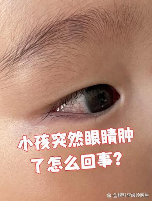 新生儿右眼肿是正常现象还是疾病信号？需要警惕哪些原因？-第2张图片-郑州医学网
