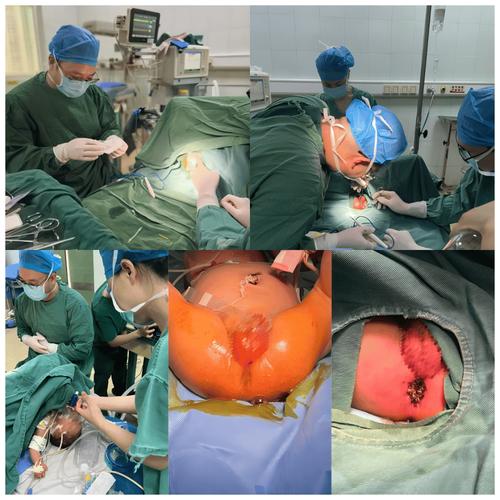 新生儿肛门手术成功率究竟有多高？不同术式和并发症风险如何影响最终效果？-第1张图片-郑州医学网