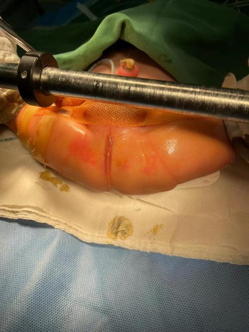 新生儿肛门手术成功率究竟有多高？不同术式和并发症风险如何影响最终效果？-第3张图片-郑州医学网