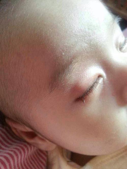 新生儿眼部血管瘤有哪些典型症状？家长该如何早期识别与应对？-第1张图片-郑州医学网