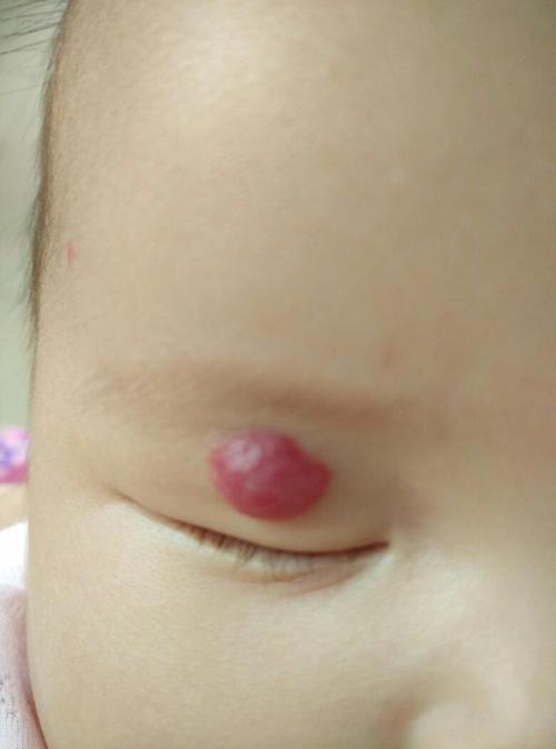 新生儿眼部血管瘤有哪些典型症状？家长该如何早期识别与应对？-第2张图片-郑州医学网