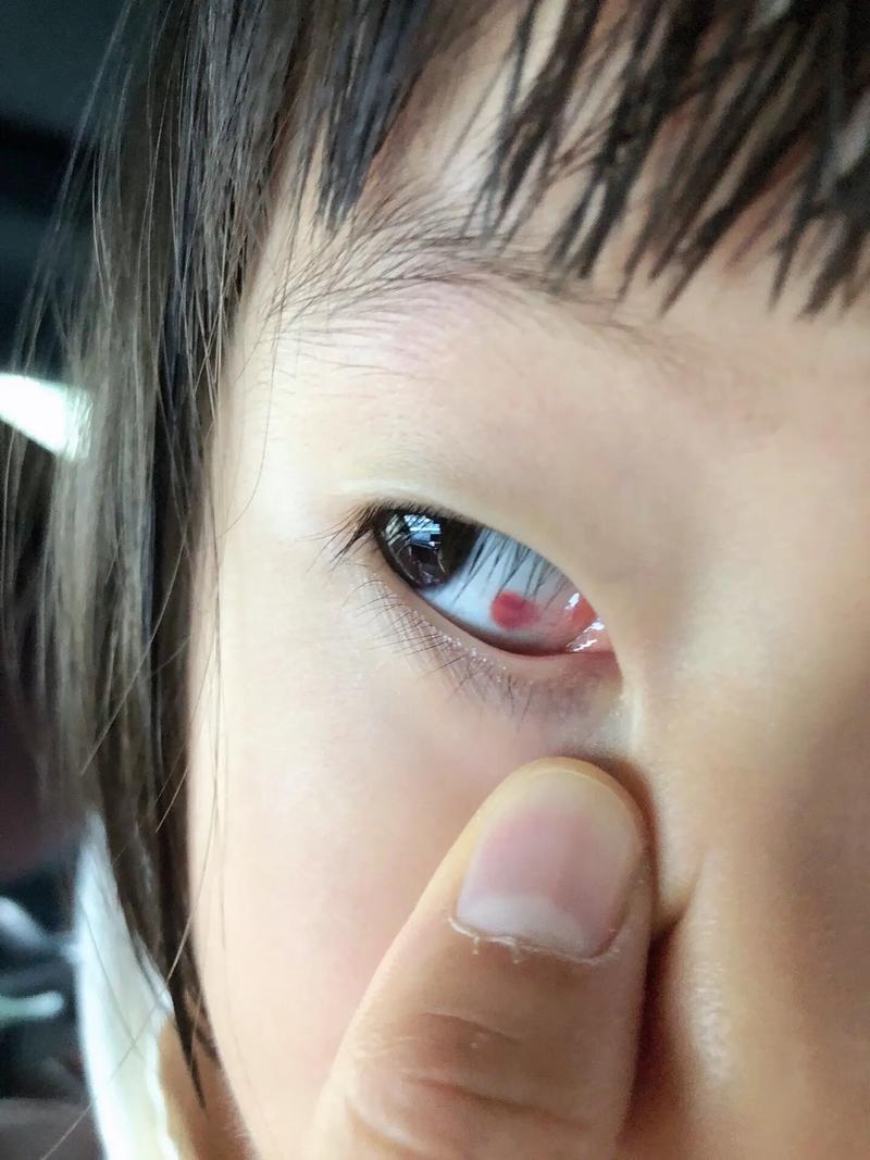 新生儿眼睛里的红血条是正常现象还是疾病信号？需要干预吗？-第1张图片-郑州医学网