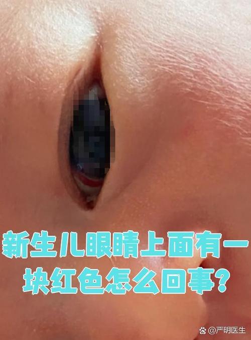 新生儿眼睛里的红血条是正常现象还是疾病信号？需要干预吗？-第3张图片-郑州医学网