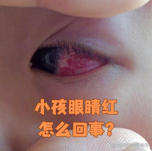 新生儿眼睛里的红血条是正常现象还是疾病信号？需要干预吗？-第2张图片-郑州医学网