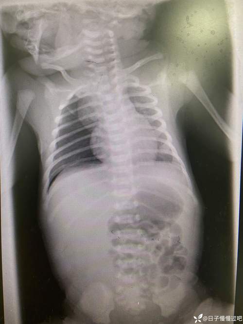 新生儿气道狭窄有哪些典型症状？家长该如何早期识别与应对？-第2张图片-郑州医学网