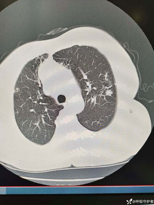 剖腹产新生儿肺部感染风险高，如何有效预防与科学护理？-第1张图片-郑州医学网