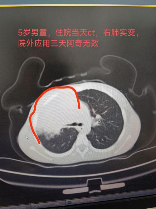 剖腹产新生儿肺部感染风险高，如何有效预防与科学护理？-第2张图片-郑州医学网