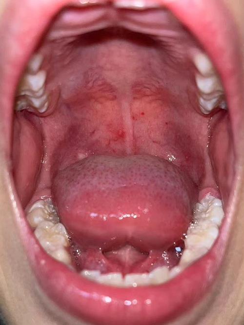 儿童疱疹性咽峡炎有哪些典型症状？如何辨别与其他儿童疾病？-第1张图片-郑州医学网