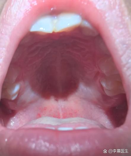儿童疱疹性咽峡炎有哪些典型症状？如何辨别与其他儿童疾病？-第2张图片-郑州医学网