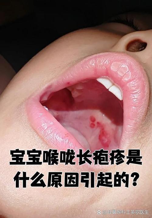 儿童疱疹性咽峡炎有哪些典型症状？如何辨别与其他儿童疾病？-第3张图片-郑州医学网