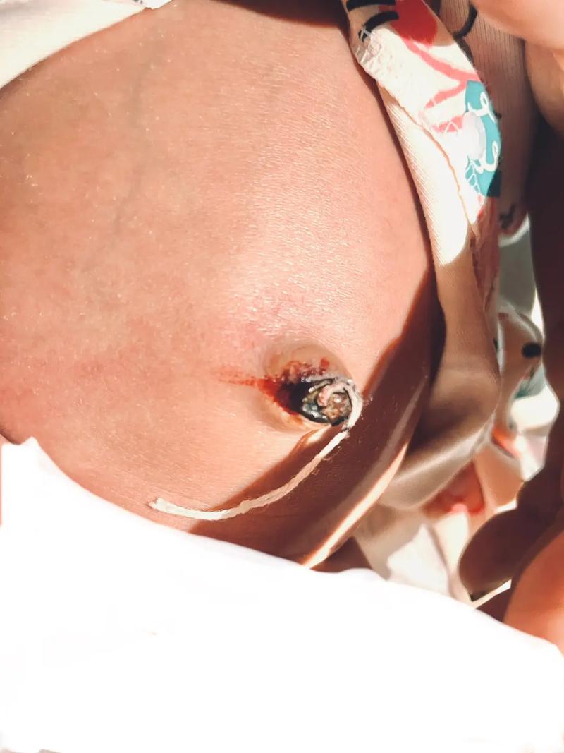 新生儿15天脐带出血是正常现象还是异常情况？需要立即就医处理吗？-第2张图片-郑州医学网